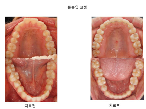 돌출입 교정	