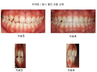 비대칭 / 앞니 절단 교합 교정	