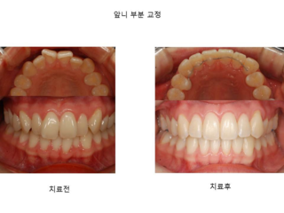 앞니 부분교정	