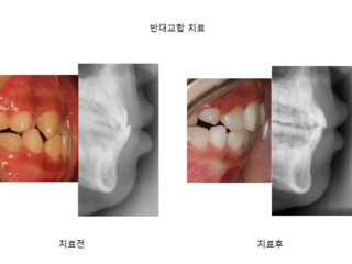 반대교합 치료	