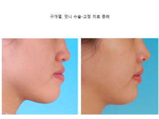 구개열 덧니 수술 교정 치료 증례	