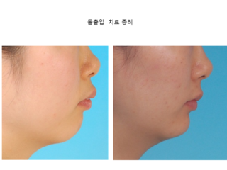 돌출입 치료 증례	