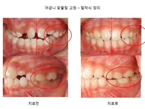 어금니 맞물림 교정 - 탈착식 장치	