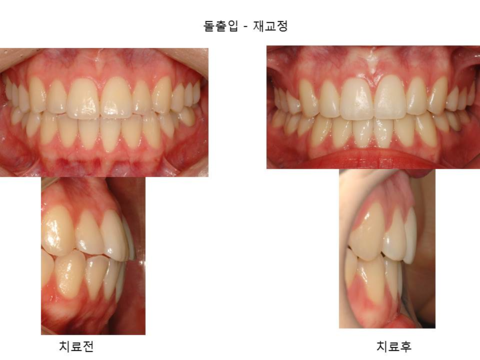 돌출입 - 재교정	