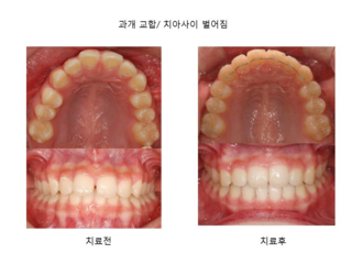 과개교합 치아사이 벌어짐	