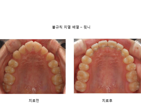 불규칙 치열 배열 - 윗니	