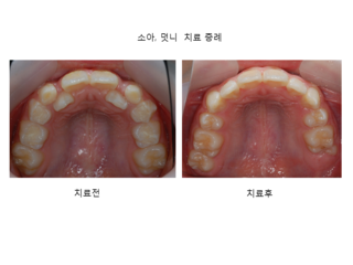 소아 덧니 치료 증례	