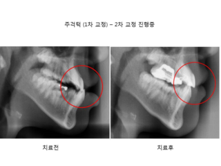주걱턱 (1차 교정)	