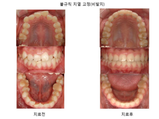 불규칙 치열 교정 (비발치)	