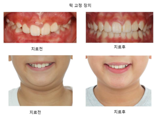 턱 교정 장치 (1차 교정)	