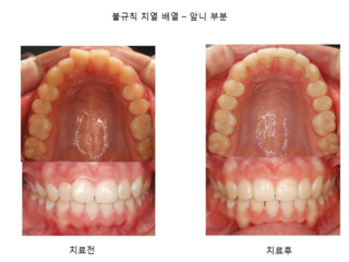 불규칙 치열 배열 - 앞니 부분	