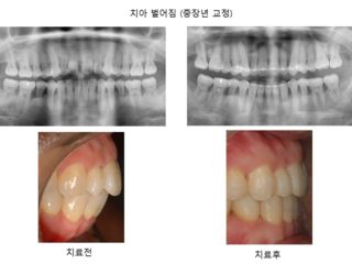 치아벌어짐 (중장년 교정)	