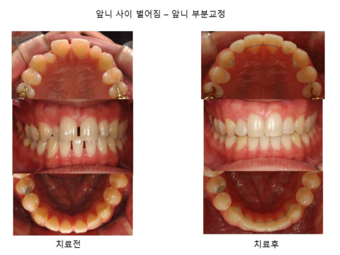 앞니 사이 벌어짐 - 부분교정	