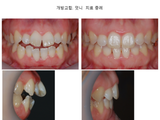 개방교합 덧니 치료 증례	
