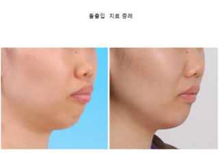 돌출입 치료 증례	