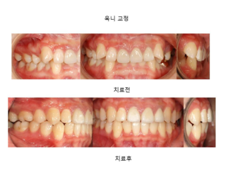 옥니 교정	