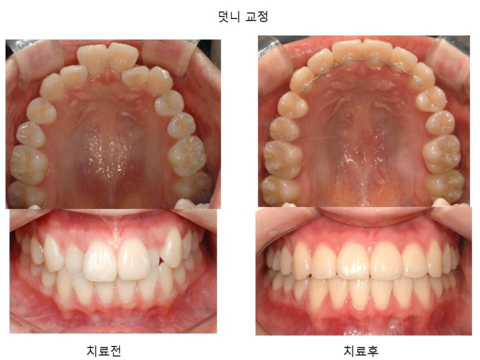 덧니 교정	