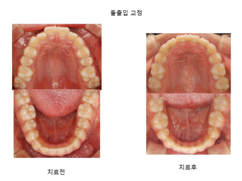 돌출입 교정	