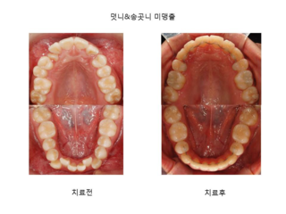 덧니 & 송곳니 미맹출	