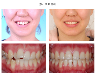 덧니 치료 증례	