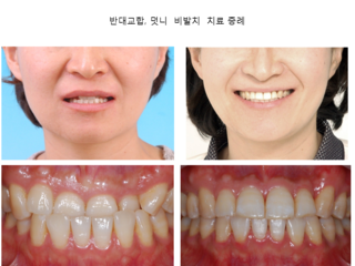 반대교합 덧니 비발치 치료 증례	