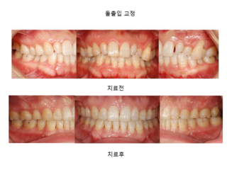 돌출입 교정	