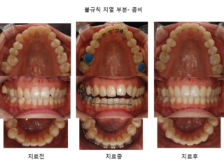 불규칙 치열 부분 콤비	