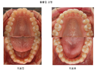 돌출입 교정	