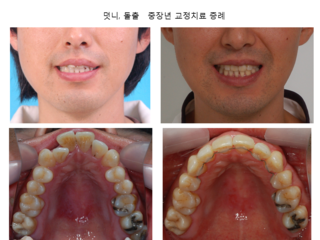 덧니 돌출 중장년 교정치료 증례	