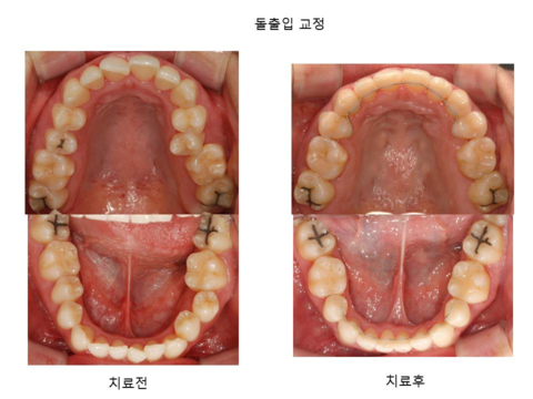 돌출입 교정	