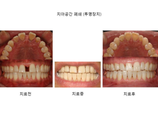 치아 공간 폐쇄 ( 투명장치교정 )	