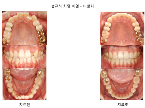 불규칙 치열 배열	
