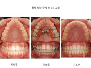 윗턱 확장 장치 후 2차 교정	