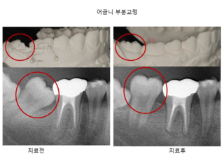 어금니 부분 교정	