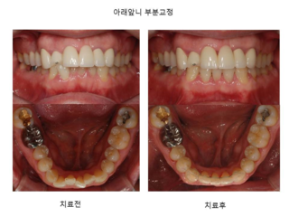 아래 앞니 부분교정	
